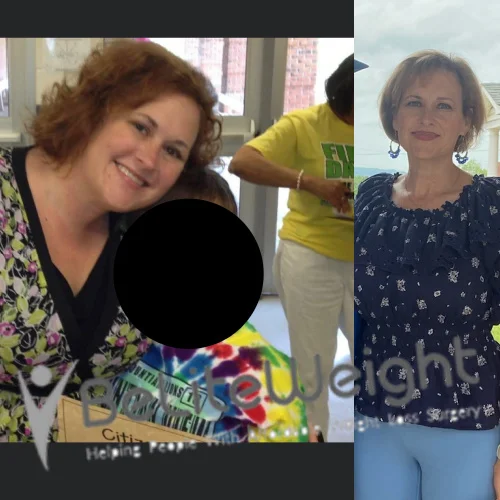 Weight Loss Surgery Before And After Jennifer E - 1 Year Update*